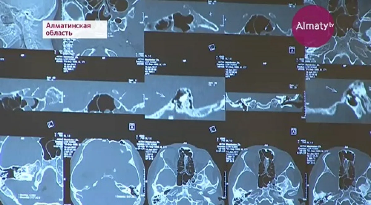 Уникальную операцию по восстановлению слуха у детей впервые провели казахстанские хирурги
