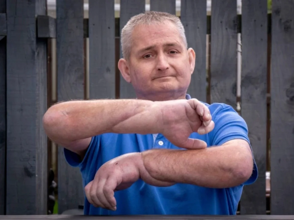 Steven Gallagher, from Dreghorn, Ayrshire, is the first person in the world to have a double hand transplant after suffering from the rare disease scleroderma. (Credits: PA)